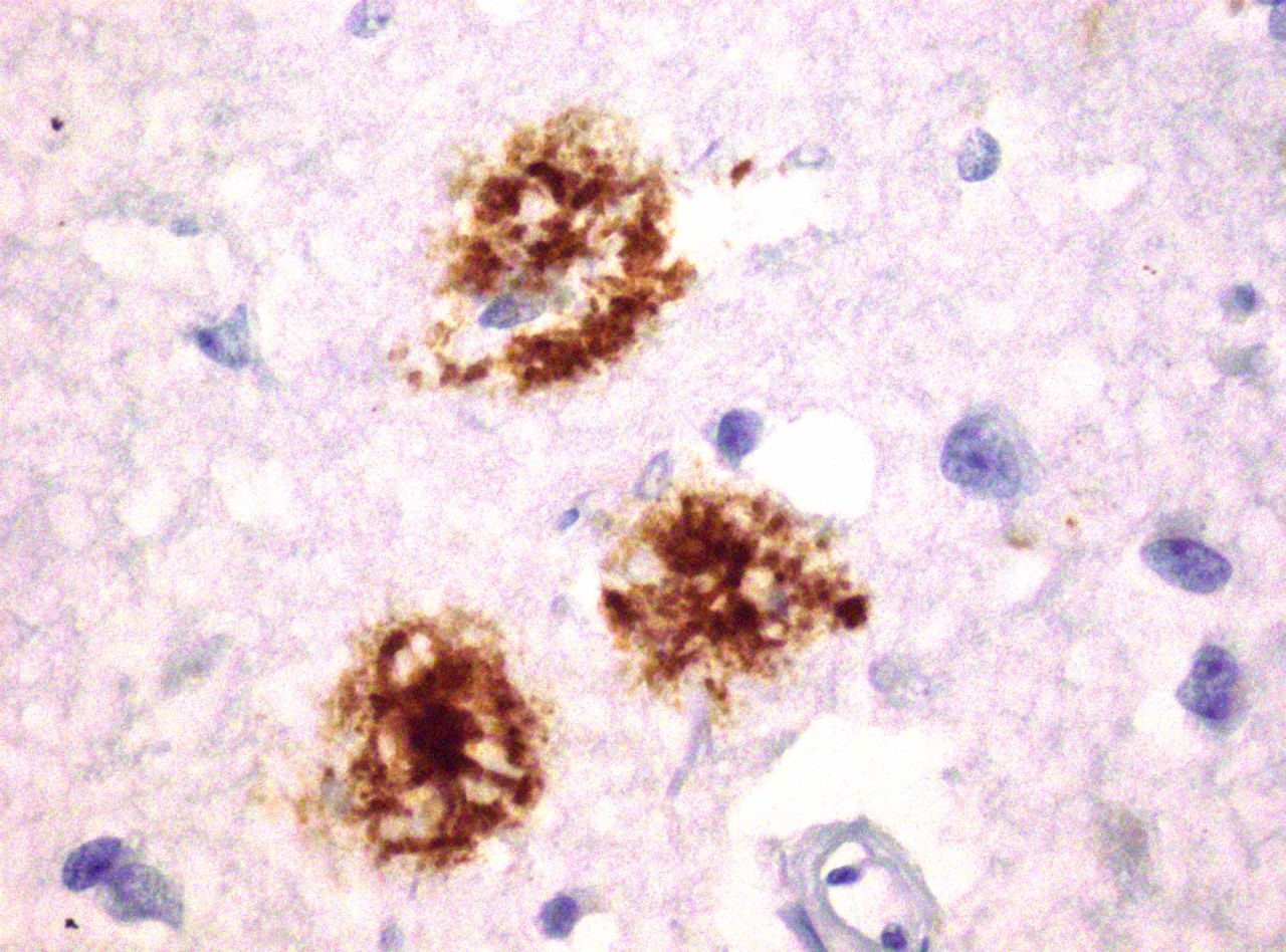 Mediathek Bild Senile Plaques bei Alzheimer