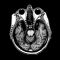 Ein Schnitt durch das Gehirn von Patient H.M. © Suzanne Corkin