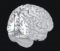 Synästhetiker haben im Vergleich zu Menschen ohne Synästhesie vermehrt graue Hirnsubstanz (helle Flächen) im Bereich des unteren linken Scheitellappens (rot) und des rechten unteren Schläfenlappens (gelb). Die Region im unteren Schläfenlappen ist auf die Farbwahrnehmung spezialisiert, der Scheitellappen für die Verknüpfung von Sinneseindrücken zuständig. © Forschungszentrum Jülich/ Weiss-Blankenhorn