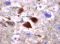 Falsche Faltung von Protein-Bruchstücken (beta-Amyloid) führt zu Plaques, wie sie typisch für Alzheimer sind. © Dr. Jakob Matschke / UKE Hamburg