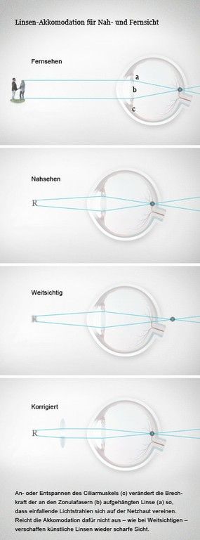 Normalerweise ist das Auge perfekt auf den Wechsel von Nah- zu Fernsicht eingestellt. Bei Fehlsichtigen aber ist die Anatomie nicht ganz normgerecht. Sie haben Probleme, die Umwelt scharf zu sehen. Grafiker: 3delux.