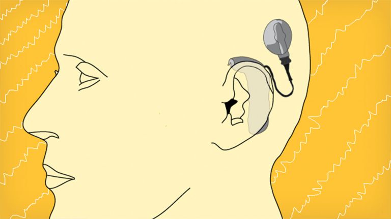 Cochlea Implantate