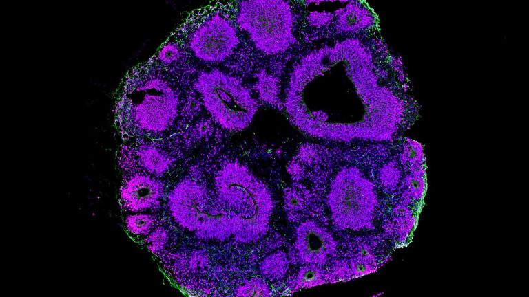 Ein Hirnorganoid (Mensch) besteht aus einer dreidimensionalen Struktur unterschiedlicher Hirnzellen. Magenta: Vorläuferzellen; grün: Neurone; lila: Zellkerne.