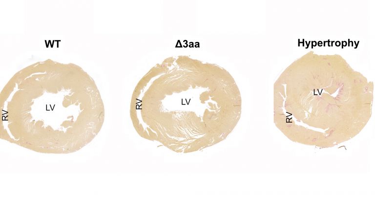 Querschnitt durch ein gewöhnliches Herz (links), durch eines der Mutanten (Mitte) und ein geschädigtes hypertrophisches Herz (rechts). Bei letzterem ist der linke Ventrikel vergrößert.