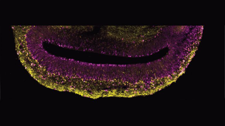 Ein Ausschnitt aus einem Hirnorganoid, das aus Stammzellen eines Menschen hergestellt wurde. In magenta sind sich aktiv vermehrende Hirnstammzellen zu sehen, in gelb eine Untergruppe von Hirnstammzellen