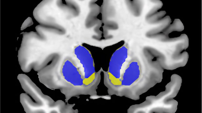 Intranasales Insulin induziert einen Anstieg des [11C] Racloprid-Bindingspotentials im Striatum, was auf eine Abnahme des synaptischen Dopamin-Spiegels hinweist.