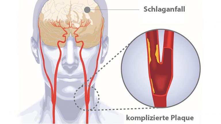 Gefährliche Plaques in der Halsschlagader