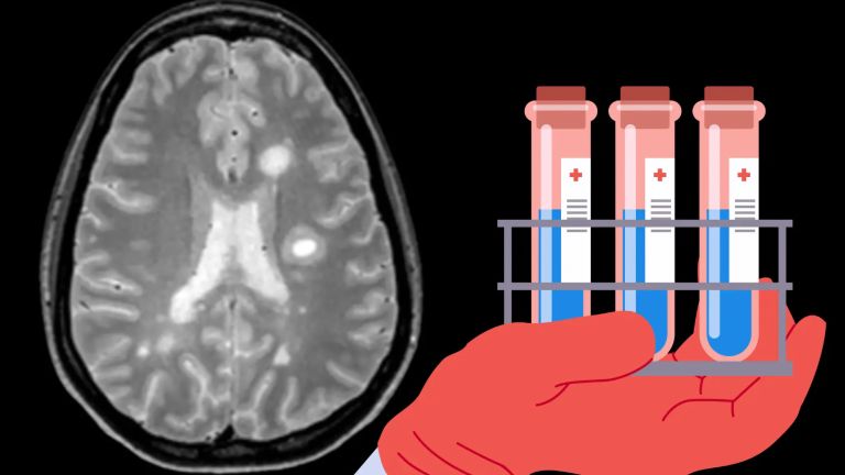 Für die Diagnose von Multiple Sklerose (MS) ist neben der Bildgebung die Laboranaltik wichtig. Neue Diagnostische Markerproteine wurden mithilfe einer umfangreichen Proteomanalyse entdeckt, die MS besser als zuvor von anderen neurologischen Erkrankungen abgenzen.  