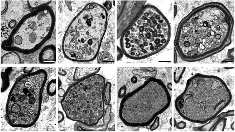 Die Bilderserie zeigt elektronenmikroskopische Aufnahmen einzelner Nervenfasern in MS-Hirnbiopsien im Querschnitt. Zu sehen sind mit Myelin (schwarze Ringe) ummantelte Axone, die von 1 bis 8 zunehmend starke Schädigungen aufweisen.