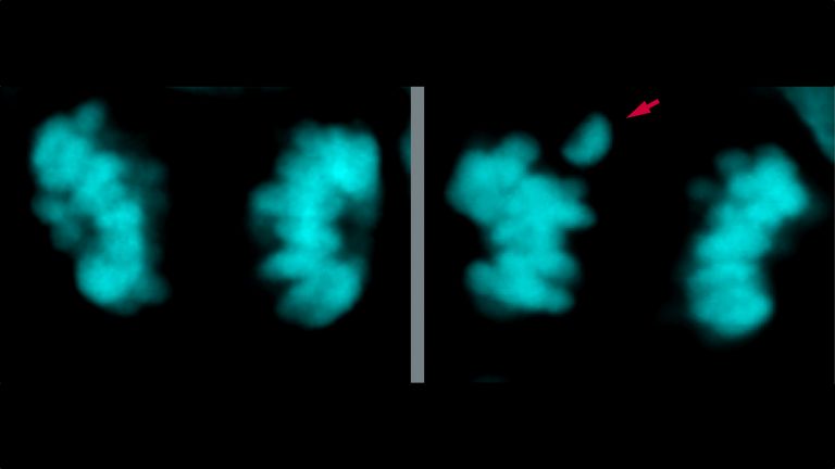 Links: Mikroskopaufnahme der Chromosomen (in Cyan) einer neuronalen Stammzelle des modernen Menschen im Neokortex während der Zellteilung. Rechte Seite: dieselbe Aufnahme, aber von einer Zelle, in der drei Aminosäuren in den beiden Proteinen KIF18a und KNL1, die an der Chromosomentrennung beteiligt sind, von der modernen menschlichen Variante zur Neandertaler-Variante verändert wurden. Diese "neandertalisierten" Zellen weisen doppelt so viele Chromosomenverteilungsfehler auf (roter Pfeil). 