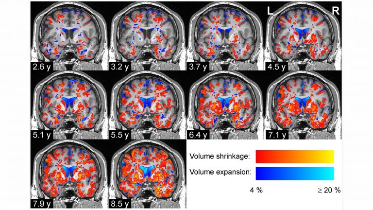 Fortschreitende Degeneration des Hirngewebes bei einem Parkinson-Patienten