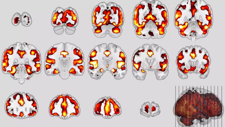Neuroanatomische Muster der behaviouralen Variante der frontotemporalen Demenz und der Schizophrenie 