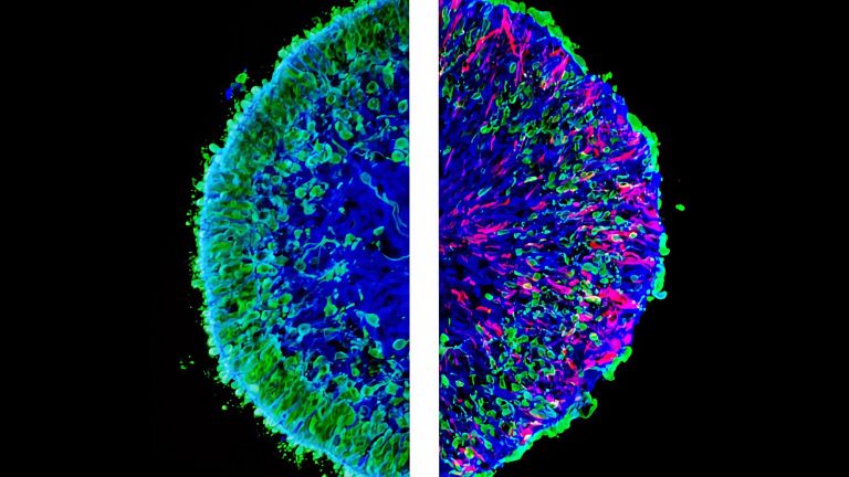 Mikroskopische Aufnahmen von im Labor gezüchteten Mini-Netzhäuten, so genannten menschlichen Netzhaut-Organoiden. Das linke Bild zeigt einen Schnitt eines gesunden (Kontroll-)Organoids. Das rechte Bild zeigt einen Organoidschnitt mit pathologischen Veränderungen.