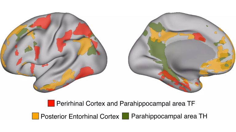 Die Forscher konnten kortikale Netzwerke identifizieren, die mit dem menschlichen medialen Temporallappen verbunden sind und die der bisherigen Gedächtnisforschung unbekannt waren.